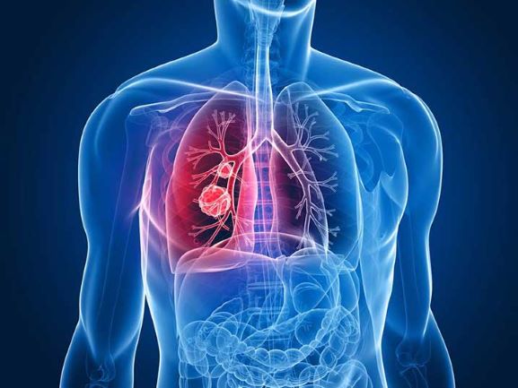 Kanser paru-paru memiliki kadar ‘survival’ terendah | SJMC Dr Matin Mellor