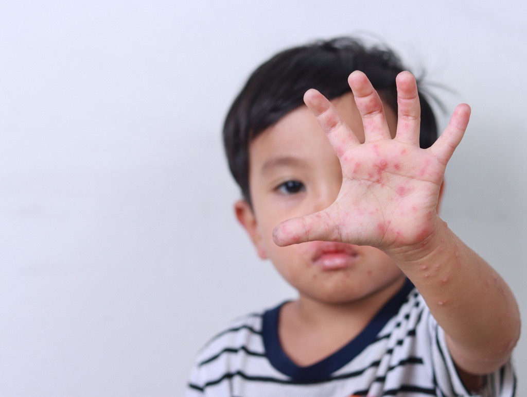 Hand, Foot and Mouth Disease (HFMD): What Parents Should Know | SJMC
