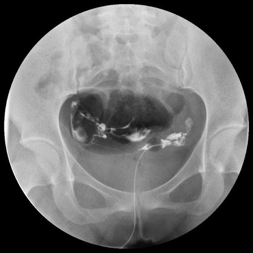 HSG X-ray of reproductive organs