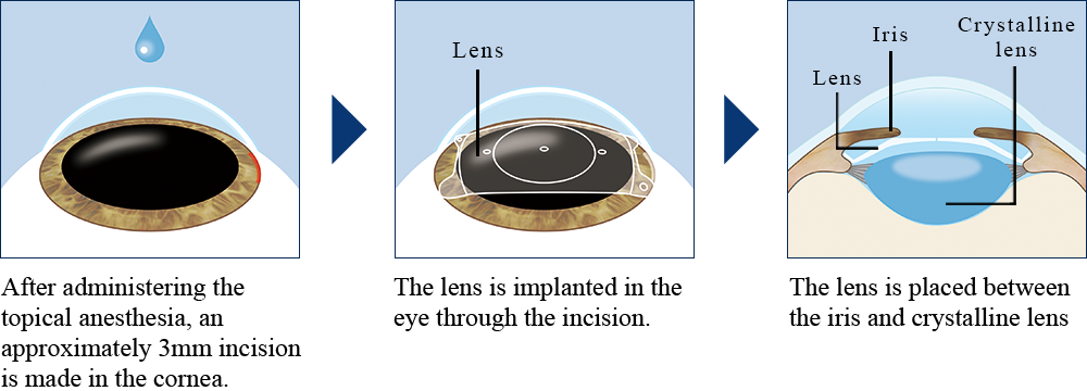 Implantable Contact Lens