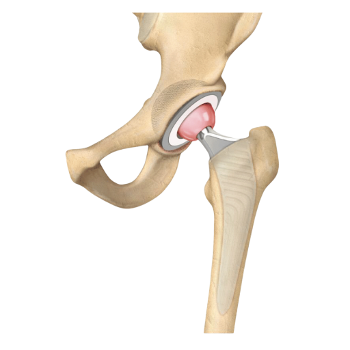 Total Hip Replacement MAKO Robotic Surgery SJMC Malaysia