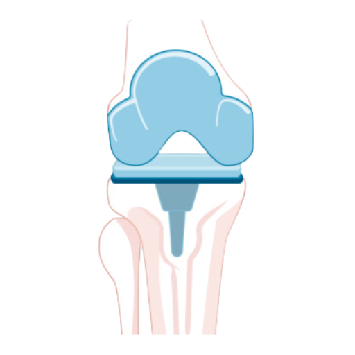 Total Knee Replacement MAKO Robotic Surgery SJMC Malaysia