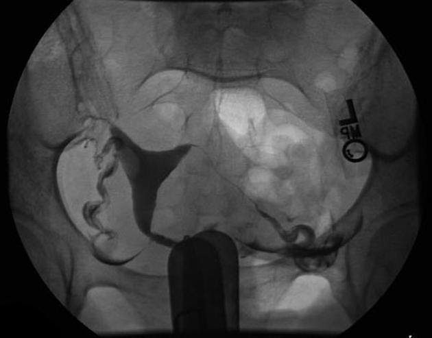 HSG (hysterosalpingography) X ray test