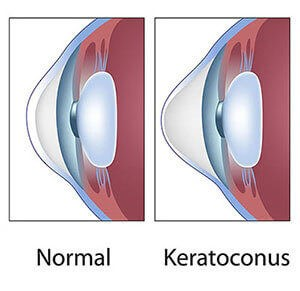 Keratoconus Treatment and Management