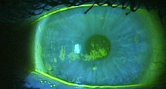 Corneal Staining indicates Moderate to Severe Dryness