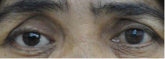 Eye Removal Surgery of Oculoplastics Services