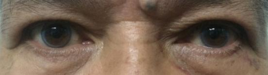 Droopy Eyelid (Ptosis) Surgery of Opthalmology Services