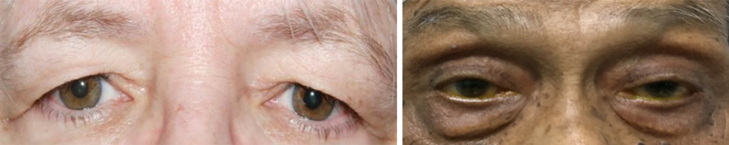 Upper & Lower Blepharoplasty (eyebags) Surgery