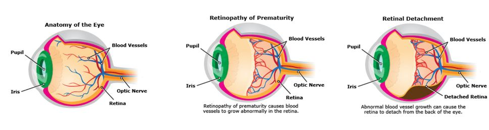 Treatment for Amblyopia or Lazy Eye