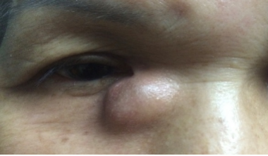 Tear Duct Disorders - Lacrimal System Infection