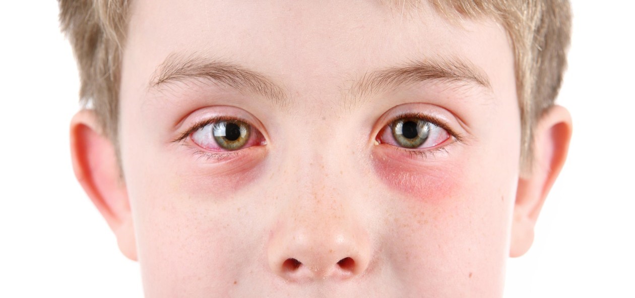 The Cause of Watery Eyes in Child - Allergic Conjunctivitis