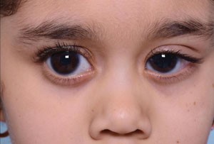 Medical Treatment for Babies' Watery Eyes