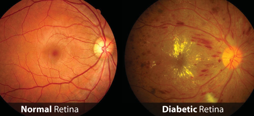 Normal Retina Vs Diabetic Retina